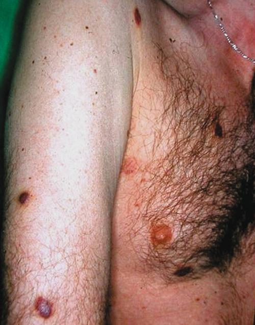 A leggyakoribb daganat, amely az AIDS-es betegekben kifejlődik a HHV-8-hoz társult Kaposi-sarcoma (3.2.36.