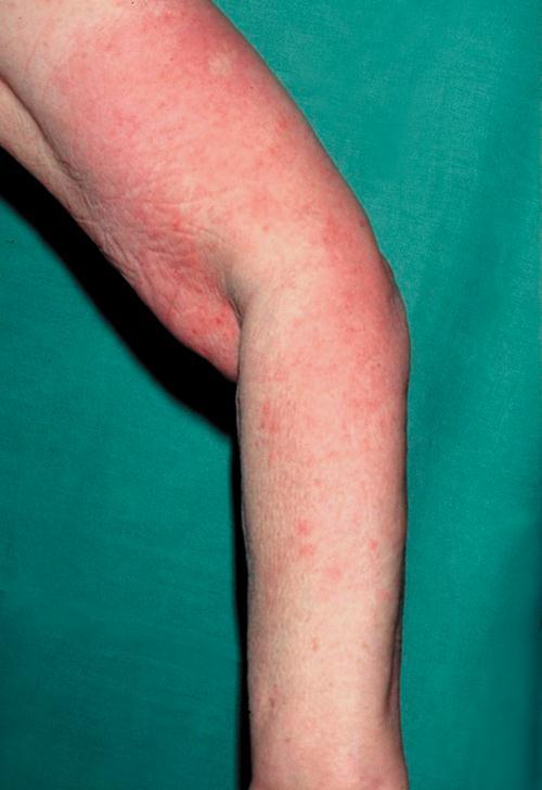 Bőrgyógyászati Intézet; Masaryk Egyetem, Brno, Csehország, felvétele), C: cellulitis (Danijela Dobrosavljevic, MD.
