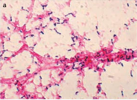 Streptococcus pneumoniae A Streptococcus pneumoniae, nem hivatalos, de elterjedt nevén pneumococcus egyaránt gyakori okozója nyálkahártya fertőzéseknek (otitis media, sinusitis, pneumonia), és