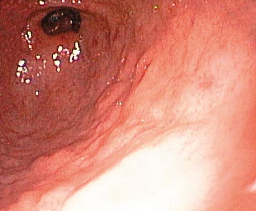 3.3.30. a. ábra. Helicobacter pylori fertőzés. A: Chronikus gastritis. (Milana Šachlová, MUDr. PhD.Masaryk Onkológiai Intézet, Brno, Cseh Köztársaság felvétele), B: Peptikus fekély.