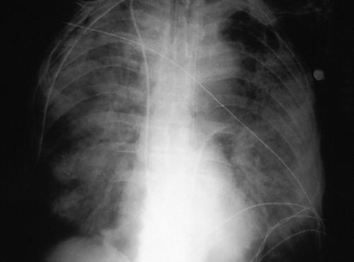 . 3.3.42. a. ábra. Legionellosis. A: legionellosisban szenvedő beteg tüdőbiopsziás mintája. Módosított Dieterle ezüst impregnáció.