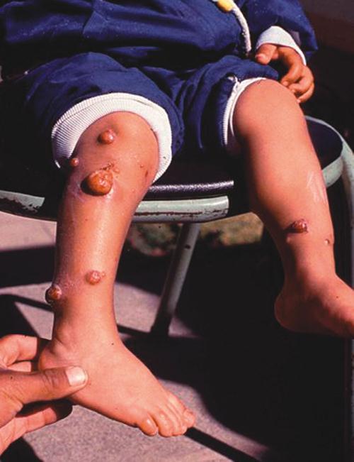 Oroya-láz Perui szemölcs (Verruga peruana) B. quintana Lövészárok láz tetű Bacillaris angiomatosis Subacut endocarditis B. henselae Bacillaris angiomatosis bolha 3.7.2.