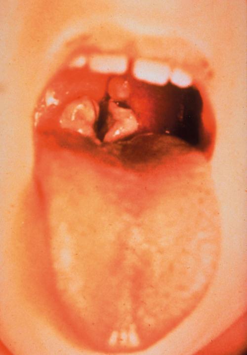 3.3.47. ábra. A diphtheria toxin hatása. Magyarázatot lásd a szövegben Kórképek A felsőlégúti infekció cseppfertőzés eredménye. A baktérium a garatképletek nyálkahártyáján szaporodik.