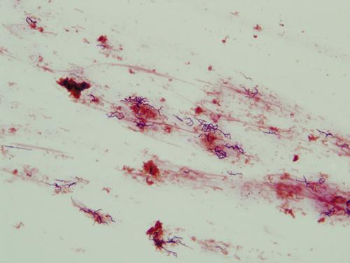 3.3.62. ábra. Actinomyces mikroszkópos képe. Az elágazódó, összefonódó nyúlványok gombára, nocardiára emlékeztethetnek.