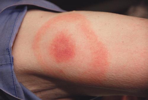3.3.73. ábra. Erythema migrans B.burgdorferi fertőzés nyomán kialakuló Lyme-kórban (CDC, Public Health Image Library, No. 9874, James Gathany felvétele) 3.11.2.3. Klinikai tünetek Visszat é r ő l á z.