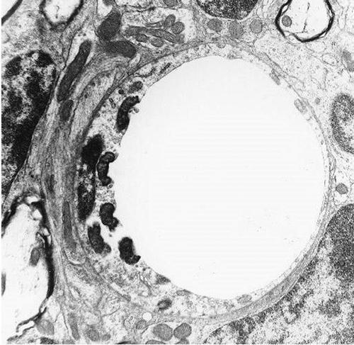 Célsejtjeik az endothel sejtek, ennek megfelelően a rickettsi fertőzéseket a kiserek gyulladása, a vasculitis jellemzi (3.3.83. ábra). 3.3.83. ábra. Az endothel sejtek fertőzése.