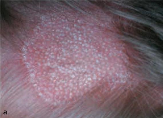 3.4.5. a. ábra. Mycosis capitis.