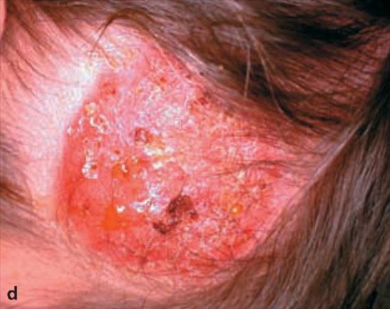 3.4.5. a. ábra. Mycosis barbae (3.4.6. ábra).