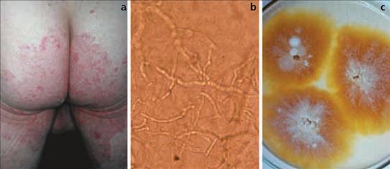 3.4.6. b. ábra. Mycosis corporis (3.4.7. ábra, 3.4.8. ábra). Az arcszőrzet- és hajmentes területek valamennyi gombás fertőzése ide sorolható.