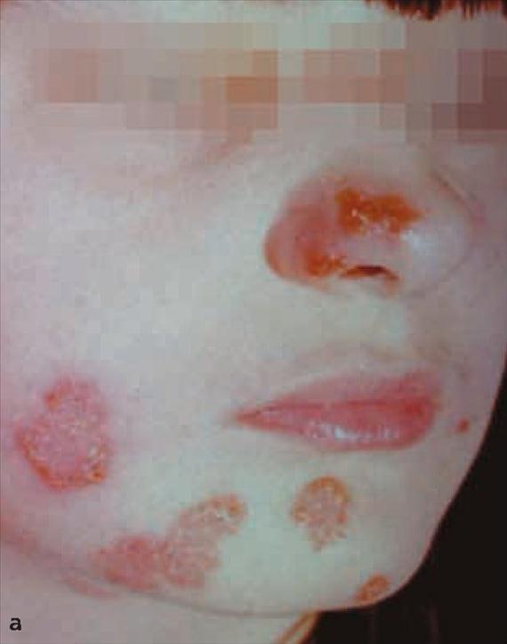 3.4.8. a. ábra. Mycosis corporis II.