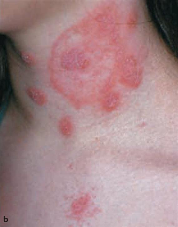 3.4.8. b. ábra. A láb gombás fertőzése, a mycosis pedis ma már népbetegség (3.4.9. ábra). Leggyakrabban antropofil Trichophyton fajok, ritkán Epidermophyton floccosum okozzák.