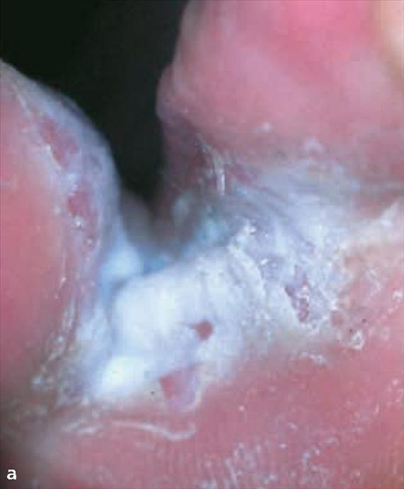 3.4.9. a. ábra. Láb és kéz mycosis. A: interdigitális miycosis, B: mokasszinláb.
