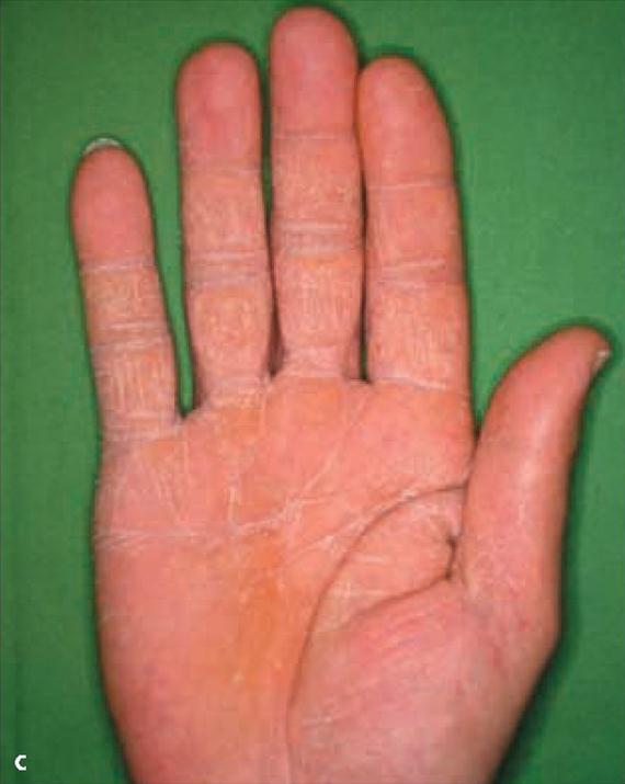 3.4.9. b. ábra. 4.2.2. Dermatomycosisok 4.2.2.1. Sarjadzógombák okozta dermatomycosisok A legfontosabb kórokozó a Candida albicans.