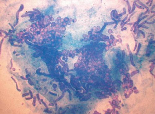 3.4.11. c. ábra. 4.2.2.2. Onychomycosis Az onychomycosis tulajdonképpen a körömlemez gomba általi krónikus károsodását jelenti.