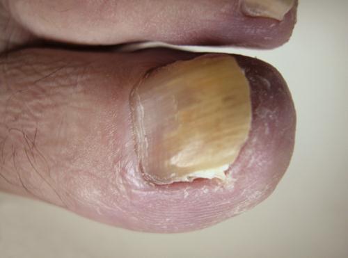 Leggyakoribb kórokozói lábkörmökön dermatophytonok (T. rubrum és T. mentagrophytes) (3.4.12. ábra), de kézkörmökön a Candida nemzetség és egyéb sarjadzógombák dominálnak.