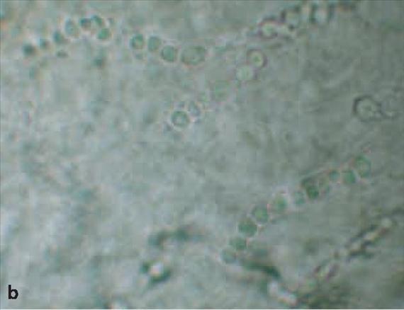 3.4.12. b. ábra. 3.4.13. ábra. Aspergillus niger körömfertőzés.