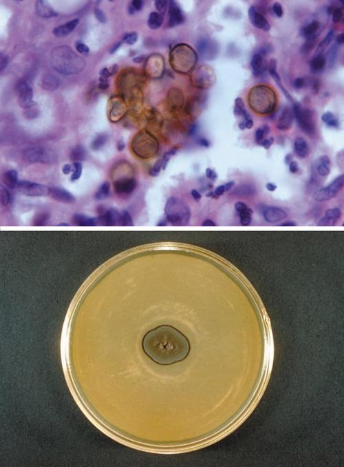 3.4.15. ábra. Chromoblastomyocosis. A: pigmentált gombaképletek egy indiai beteg szövetmintájban (Dr.