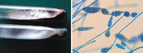 3.4.16. d., e. ábra. 4.3.4. Hyalohyphomycosis Szintén hisztológiai gombacsoport, azaz a hasonló, a sporotrichosisra, phaeohyphomycosisra emlékeztető fertőzésekben a szövettani
