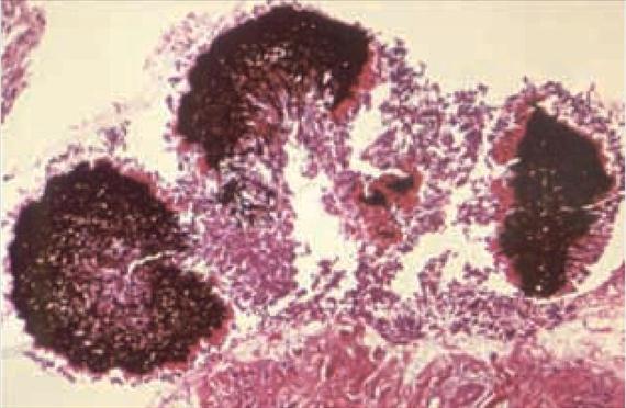 3.4.20. ábra. Mycetoma granulumok szövettani képe. Acremonium falciforme mycetoma, Gömöri és Haematoxylin-Eosin festés. (Public Health Imgage Library, CDC, Atlanta, No.