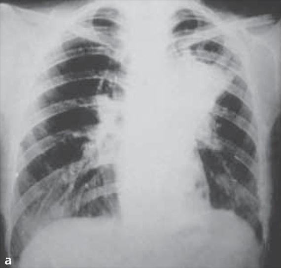 3.4.22. a. ábra. A blastomycosis klinikai megnyilvánulásai.
