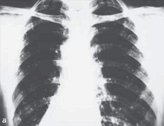 3.4.24. a. ábra. A histoplasmosis klinikai megnyilvánulásai. A: a tüdő fertőzöttsége, B: a felsőajak fertőzése.