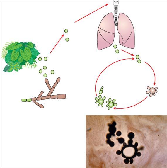3.4.26. ábra. A paracoccidioidomycosis pathogenezise. Paracoccidioides brasiliensis többszörös bimbót tartalmazó sarjadzó sejtje klinikai mintában (Public Health Image Library, CDC, Atlanta, USA. No.
