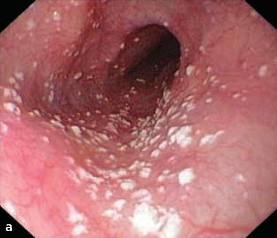 3.4.28. a. ábra. Szisztémás candidafertőzések. A: Candida oesophagitis súlyosan immunkompromittált betegben. (SciencePhoto Library, No.