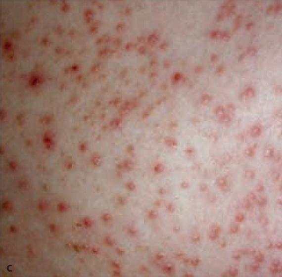 3.4.28. c. ábra. A pulmonális candidosis hematogén szóródás részeként, vagy az oropharyngealis candidosis mélybe terjedéseként alakul ki. Aspiráció révén szintén leírták kialakulását.