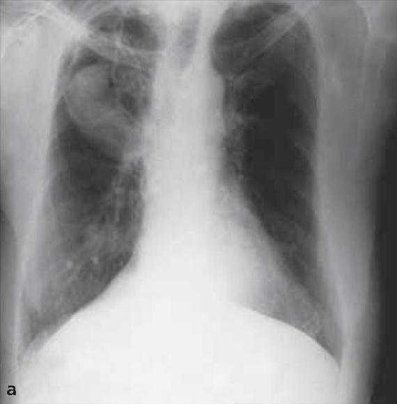 3.4.30. a. ábra. Az aspergillus fertőzés klinikai formái. A: a jobb felső tüdőlebeny aspergillomája.