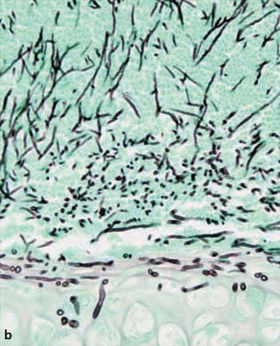 3.4.30. b. ábra. Az akut invazív tüdőaspergillosis (3.4.30. Ábra, B) főként neutropéniás, csontvelő-transzplantált, hosszan tartó corticosteroid vagy citotoxikus kemoterápiában részesült betegekben alakulhat ki.