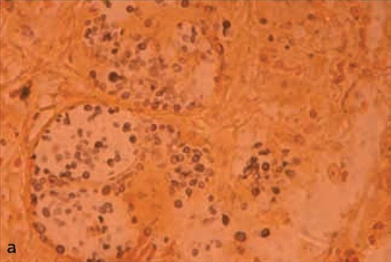 3.4.31. a. ábra. Cryptococcosis. A: invazív cryptococcosisban szenvedő 9 éves immunkompromittált beteg nyirokcsomójában látható gombasejtek.