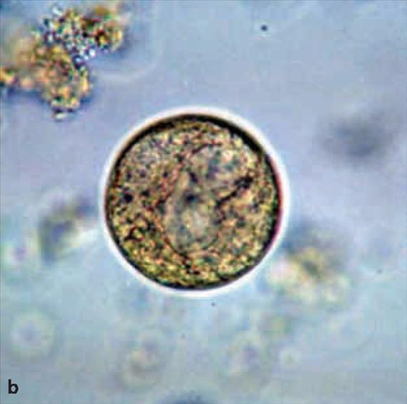 3.5.8. b. ábra. Patogenezis, klinikai kép és járványtan A világon mindenütt előforduló protozoon, de leggyakoribb a déli Távol-Keleten, a Fülöp-szigeteken és Indokínában.