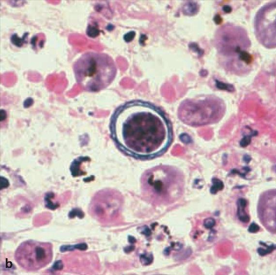 3.5.14. a. ábra. Naegleria és Acanthamoeba fertőzések. A: Naegleria fowleri agygerincvelői folyadékban. HE festés.
