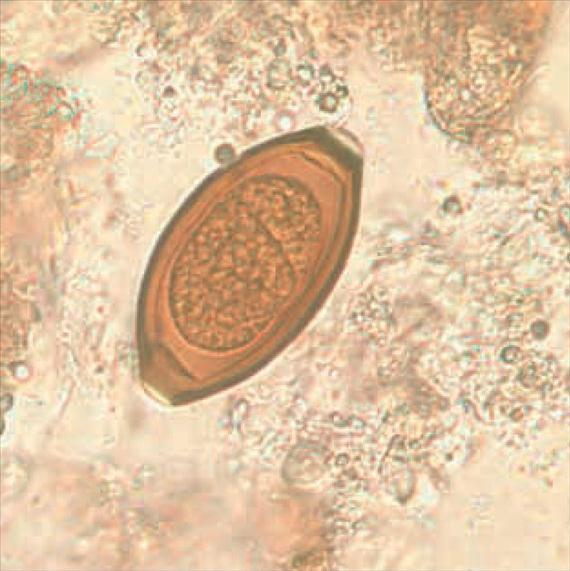A trichuriasis, a kórokozó alakja miatt ostorférgességnek is nevezett betegség okozója. Az 50 x 20 µm-es peték citromalakúak, két végükön jellegzetes, kettősen fénytörő nyák dugasszal.