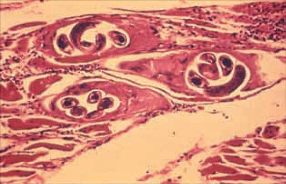 3.5.36. ábra. Encystálódott Trichinella lárvák emberi izomszövetben. CDC (USA) Public Health Image Library (PHIL), No.
