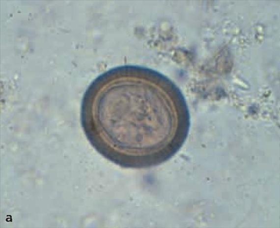 3.5.42. a. ábra. A Taeniák morfológiája. A: Taenia faj petéje (30 35 µm). Jól megfigyelhető a perem sugaras mintázata, B: T. saginata kifejlett féreg, C: T. solium proglottisok tusfestéssel.