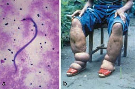 3.5.53. ábra. Wuchereria bancrofti microfilaria és elephantiasis. A: Microfilaria Giemsával festett vérkenetben, B: elephantiasis. (CDC, Public Health Image Library, No. 3008. A: Dr.