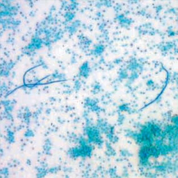 3.5.55. ábra. Loa loa microfilariák concentrált vérmintában. 100 x-os nagyítás. (CDC, Division of Parasitic Diseases, Parasite Image Library, ) Életciklus, patogenezis és klinikai kép.