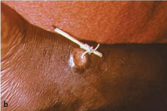 (CDC, Public Health Image Library, No. 663 és 1342. Dr.