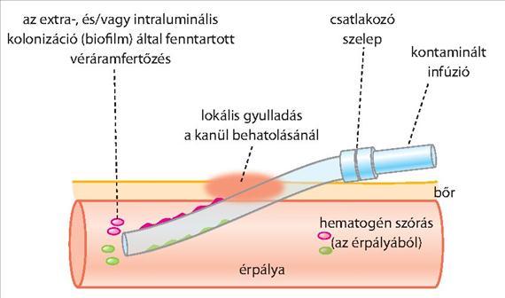 4. BEVEZETÉS A KLINIKAI MIKROBIOLÓGIÁBA 4.7.3. ábra. A kanül eredetű fertőzések.