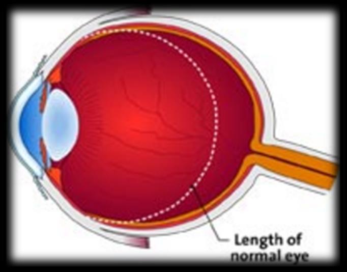 RIZIKÓFAKTOROK MYOPIA TENGELY MYOPIA megnyúlt/ feszült hátsó