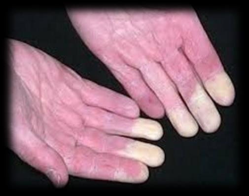 Migrain Raynaud