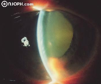 GLAUCOMA CONGESTIVUM ACUTUM Objektív tünetek pangásos vérbőség cornea borús, oedemás epithel bullák csarnok