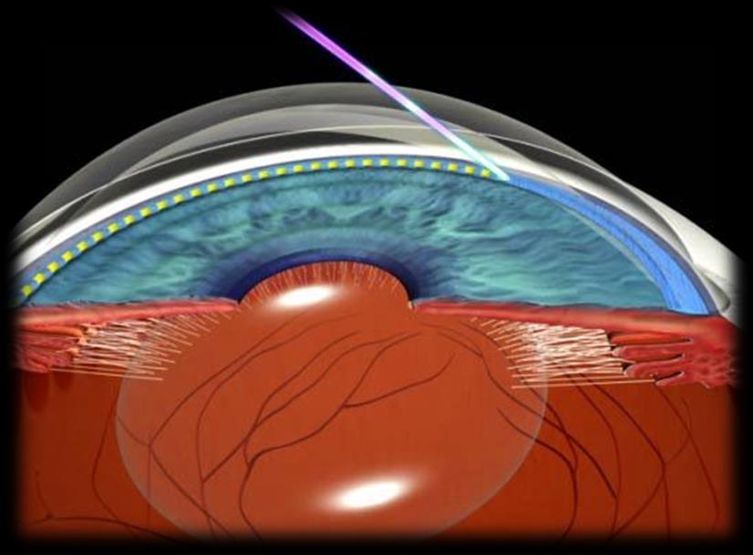 LASER TRABECULOPLASTICA Cél: biokémiai változások létrehozása a trabecularis rendszerben, mely az extracellularis állomány átépüléséhez vezet és ezáltal