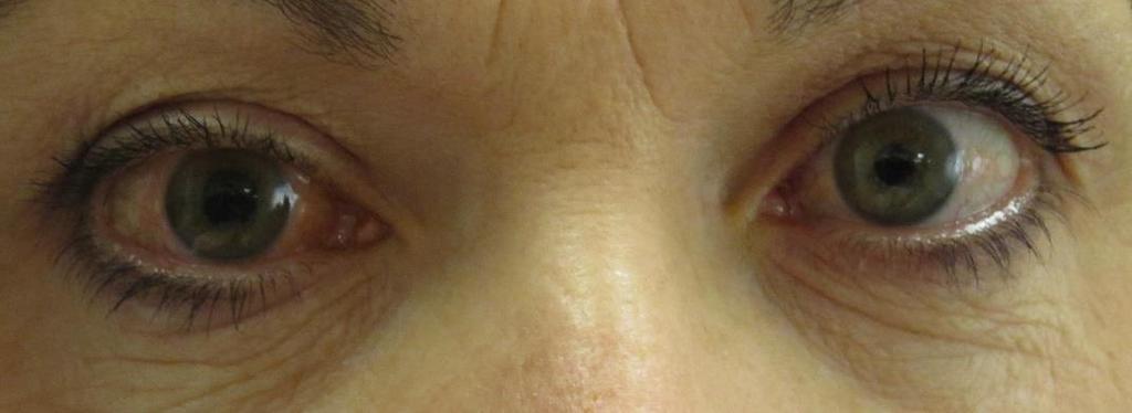https://upload.wikimedia.org/wikipedia/commons/0/07/acute_angle_closure_glaucoma.