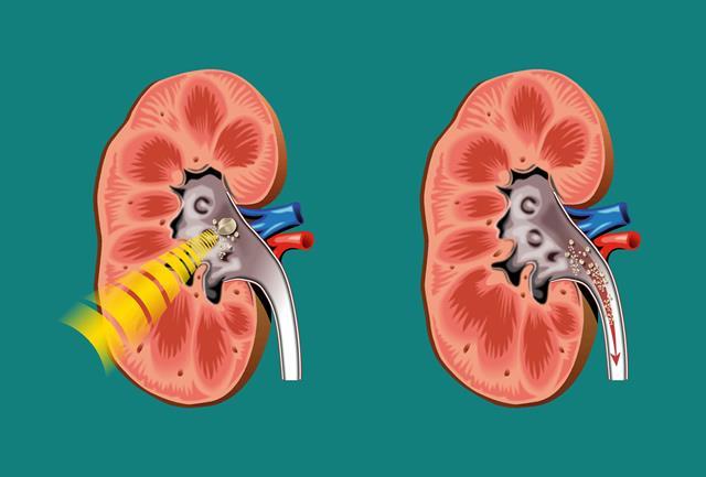 ESWL Extracorporeal Shock Wawe Lithotripsy = testenkívüli lökéshullám kezelés A