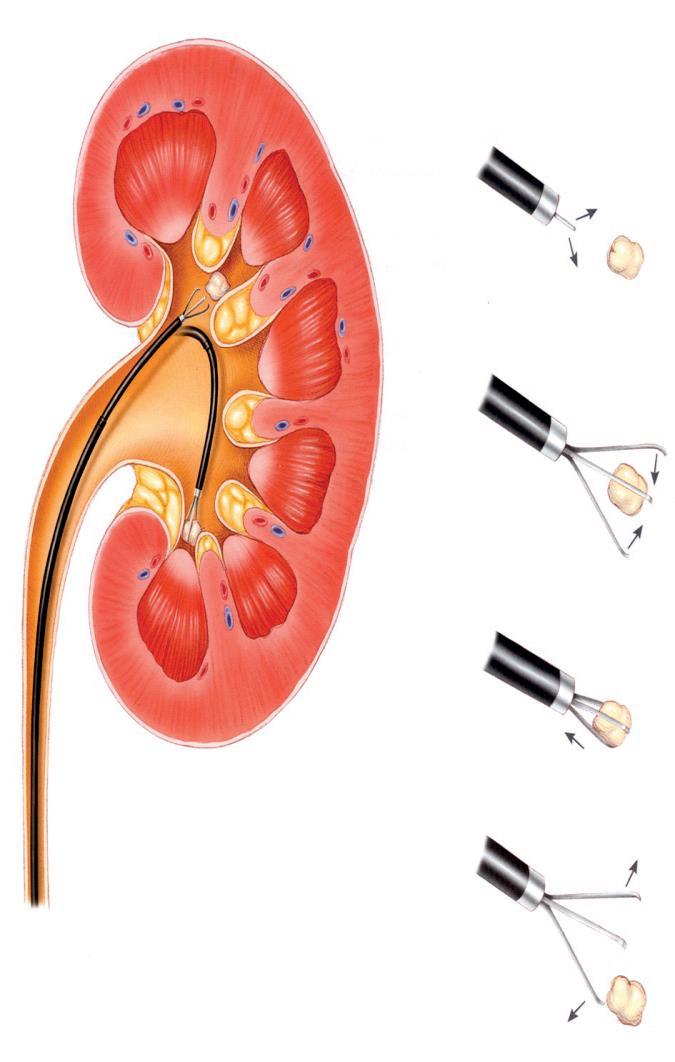 Intrarenal