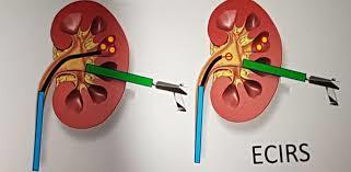 ECIRS Endoscopic Combined