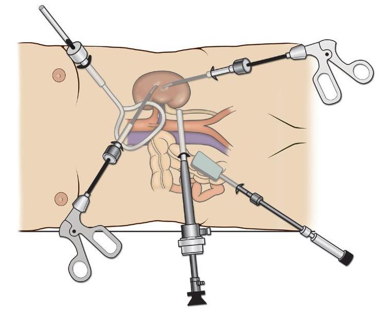 pyelotomia Lap.