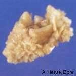 primer hyperoxaluria enteralis hyperoxaluria» malabsorptio» bélrezekció utáni áll.